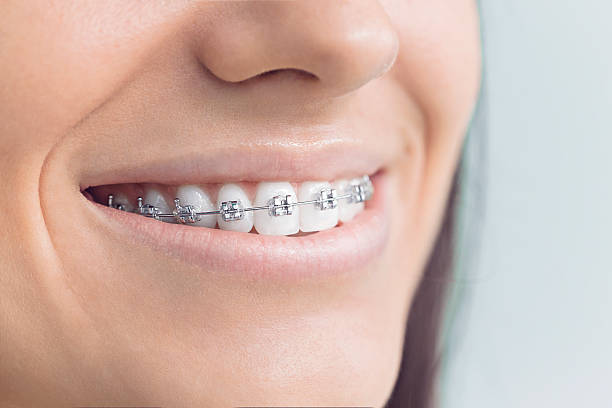 Best Veneers and Lumineers  in Ller, WA